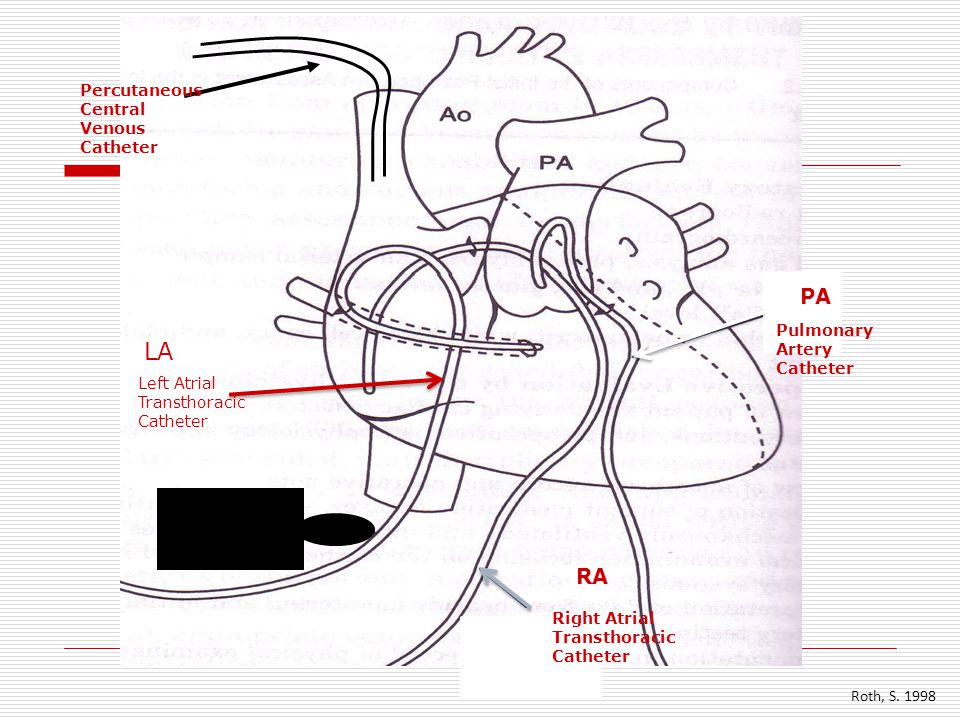 CCRN transthoracic intracardiac catheters